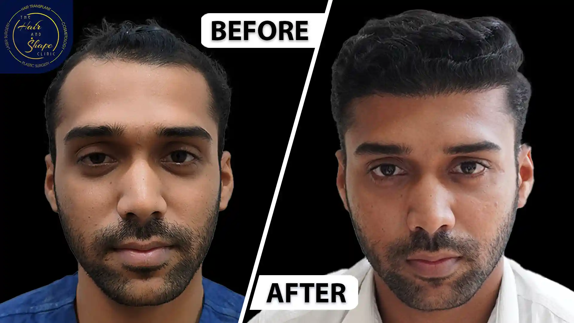 Hair Transplant result2